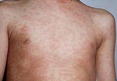 Nampula com 1.498 casos e três vítimas mortais por sarampo